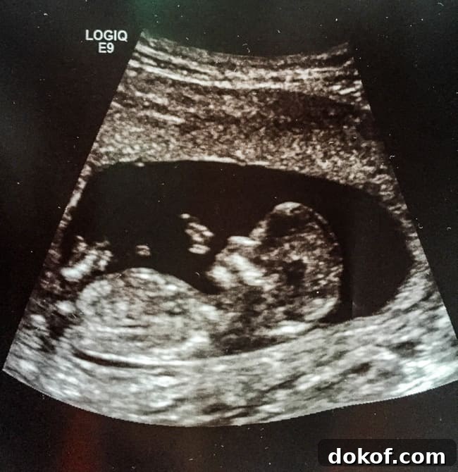 Ultrasound of baby at 12 weeks.